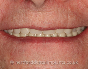 After dental implants Hertfordshire
