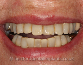 After dental implants Hertfordshire