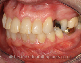 Before dental implants Hertfordshire