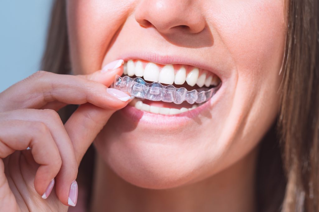 Invisalign